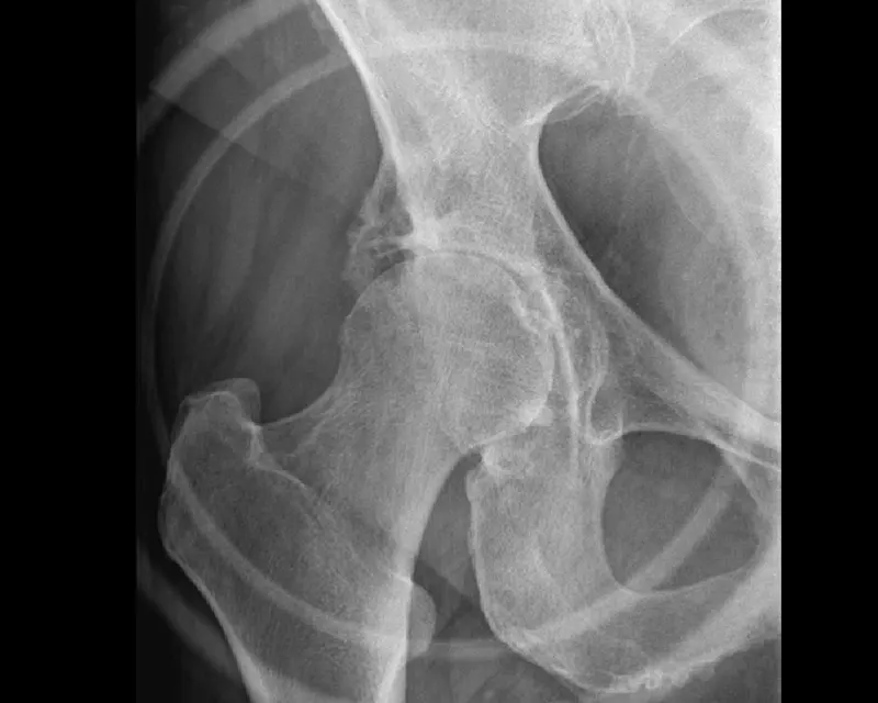 Arthrose de hanche (coxarthrose) avec quasi disparition de l'espace entre la tête du fémur et l'os du bassin