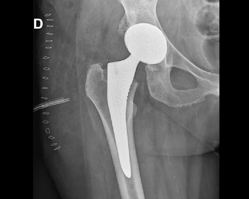 Radiographie de la même patiente le lendemain de son opération