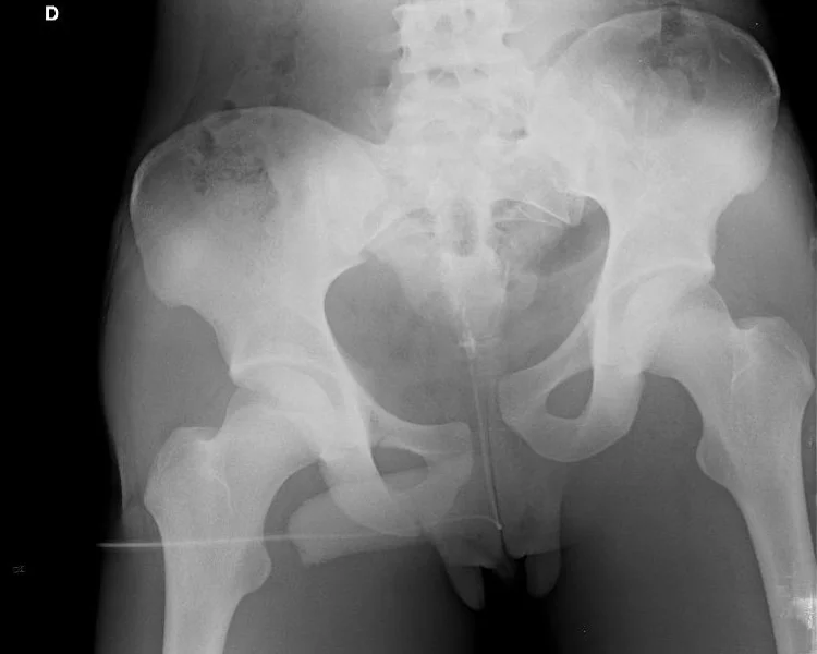 Radio fracture du fémur droit