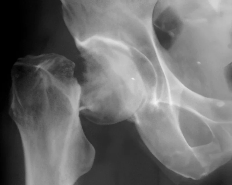 Fracture du col fémoral avec déplacement