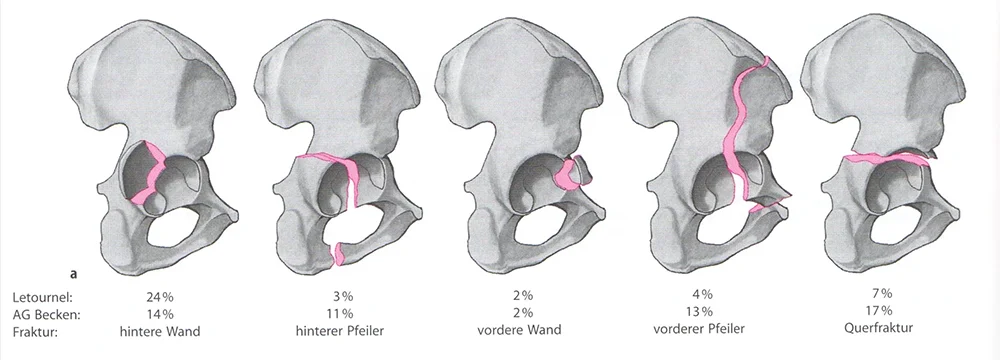 Classification des fractures du cotyle