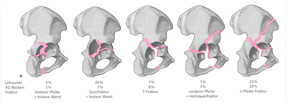 Classification des fractures du cotyle