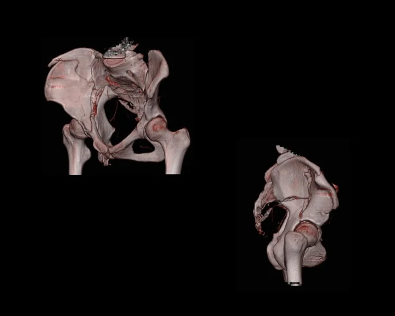 Reconstruction 3D au scanner